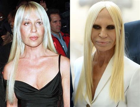 versace plastic surgery gone wrong.